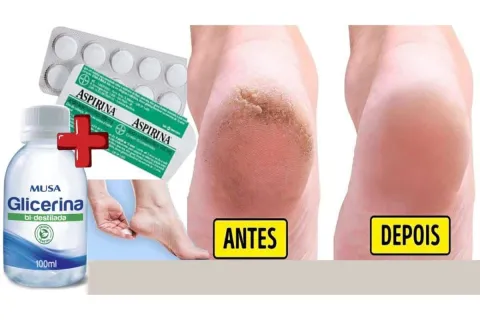 Aprendi a faze um hidratante caseiro para pés rachados que é