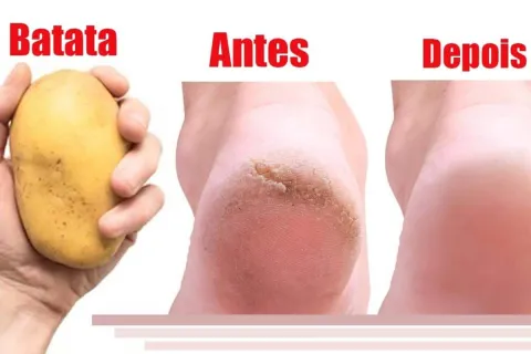 Como deixar os pés lisos: acabe com as rachaduras sem usar c