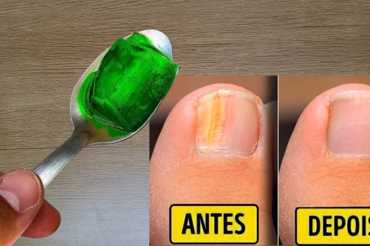 Como eliminar micose da unha: técnica fácil que aprendi com