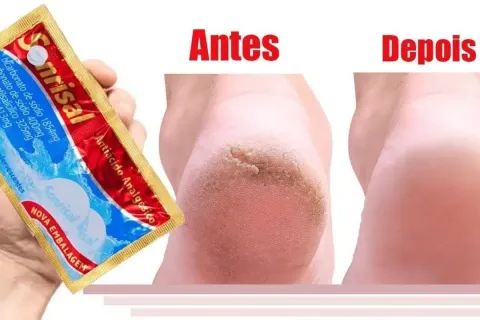 Como hidratar pés rachados e ressecados sem precisar de cosm