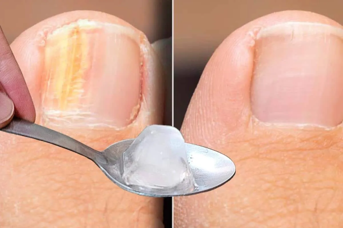 Como remover micose da unha sem precisar gastar dinheiro com