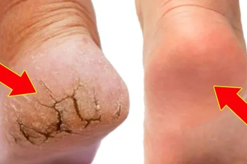 Como tirar rachadura dos pés usando 2 produtos que você tem 