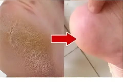 Dica caseira para pés rachados e ressecados: fica lisinho ig