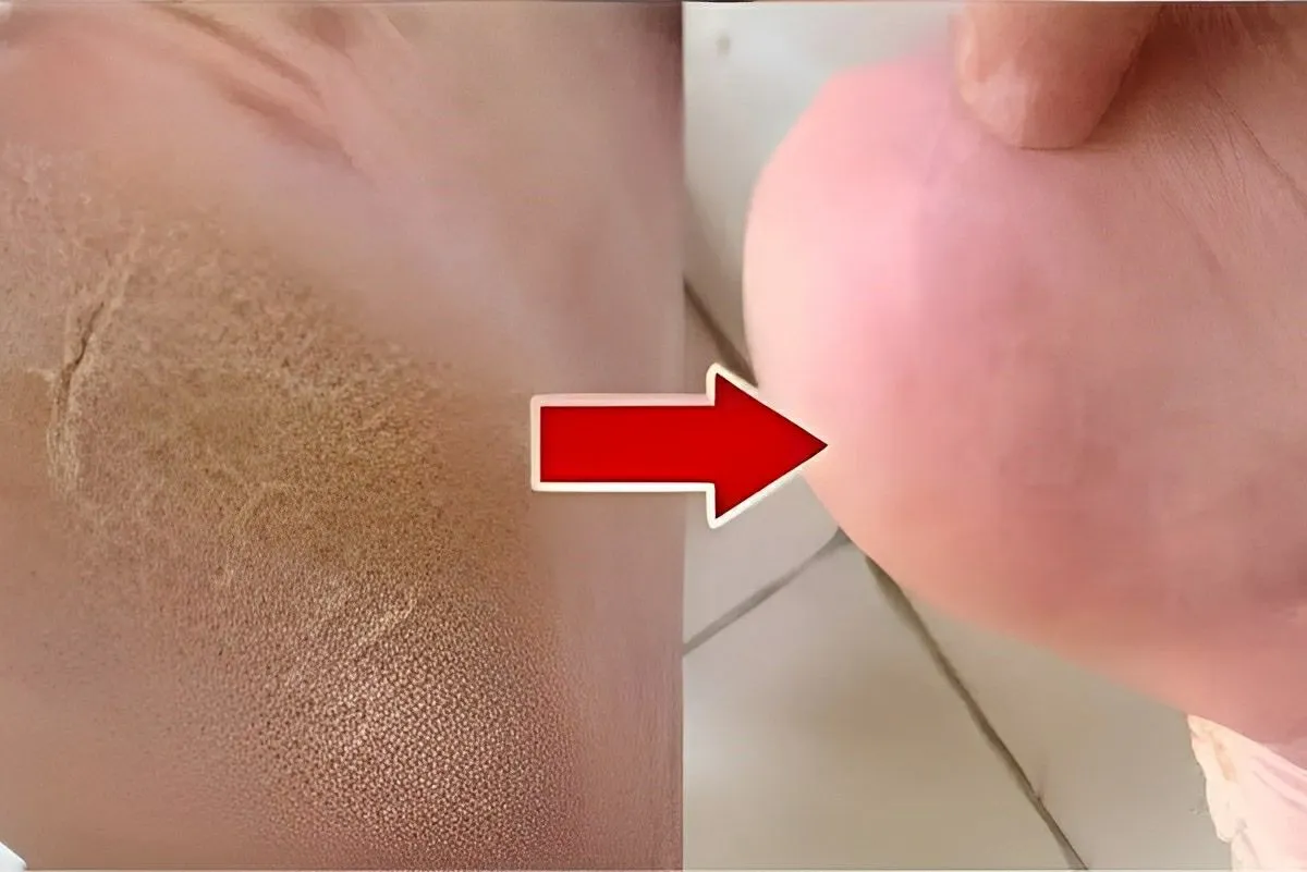 Dica para acabar com rachaduras dos pés na primeira noite os
