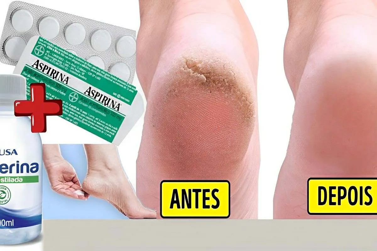 Fiz esse hidratante caseiro para pés rachados e o resultado
