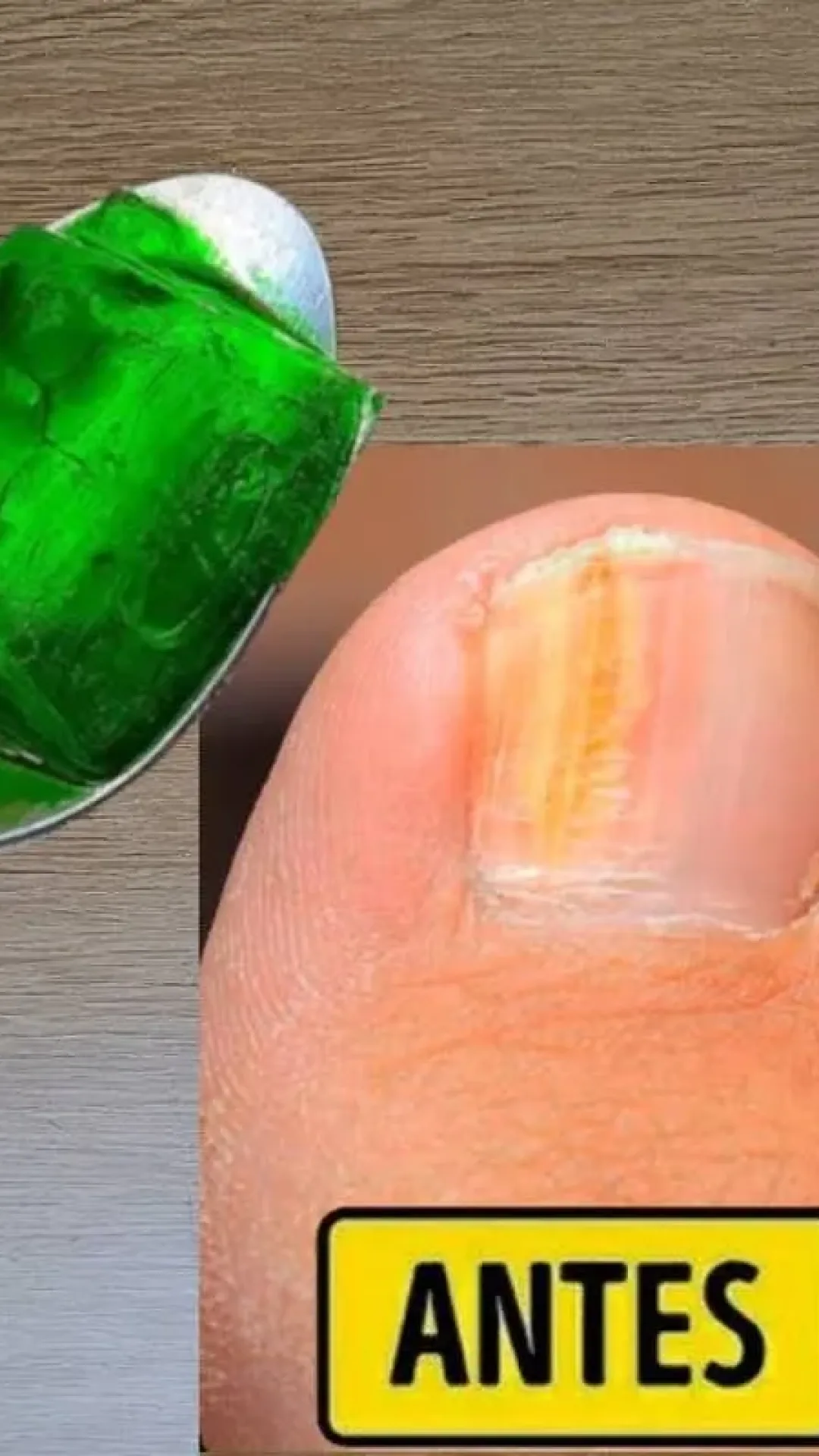 Como eliminar micose da unha: técnica fácil que aprendi com uma manicure