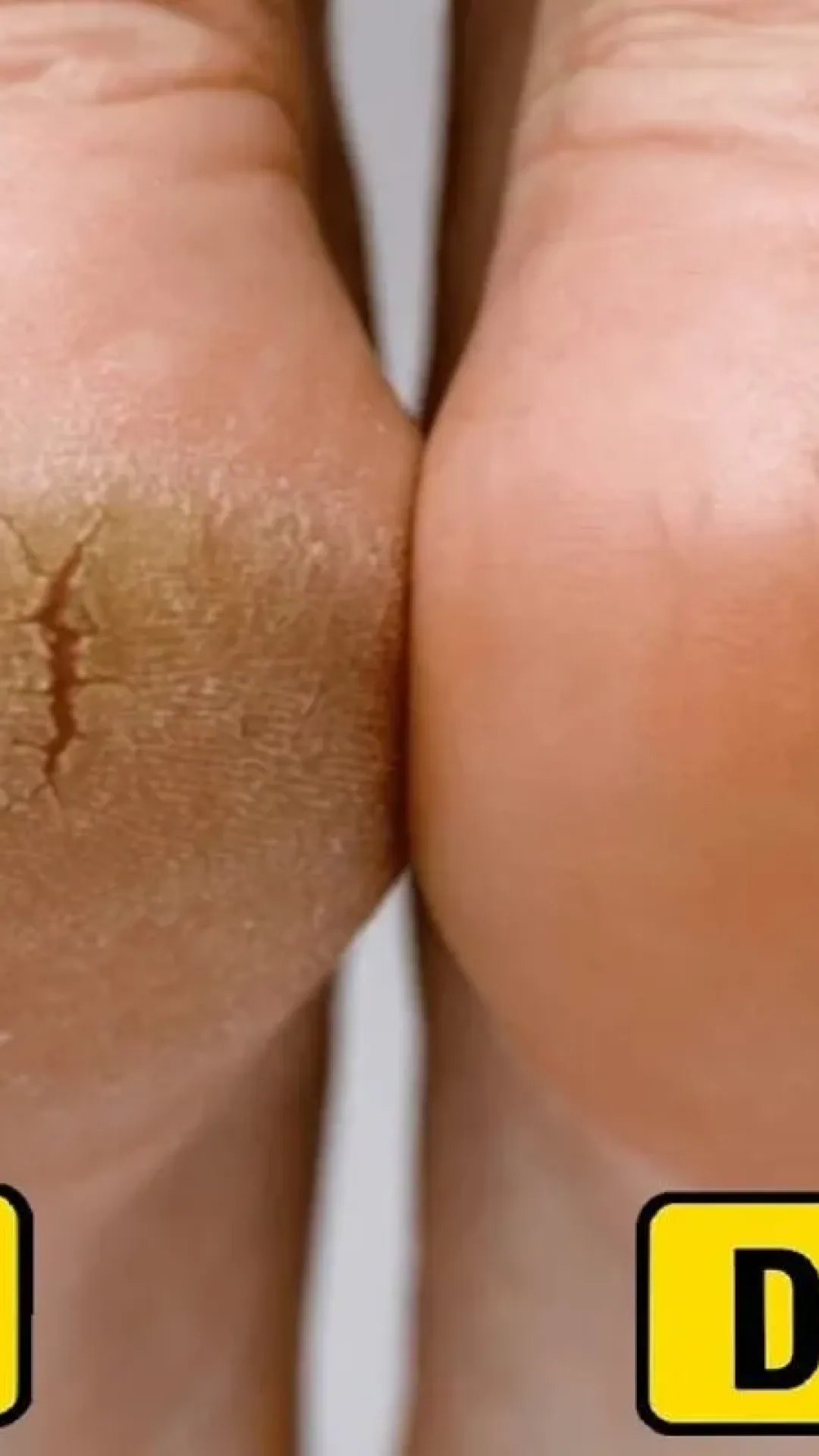 Como tirar rachadura dos pés: dica caseira e super barata para tirar todo ressecamento