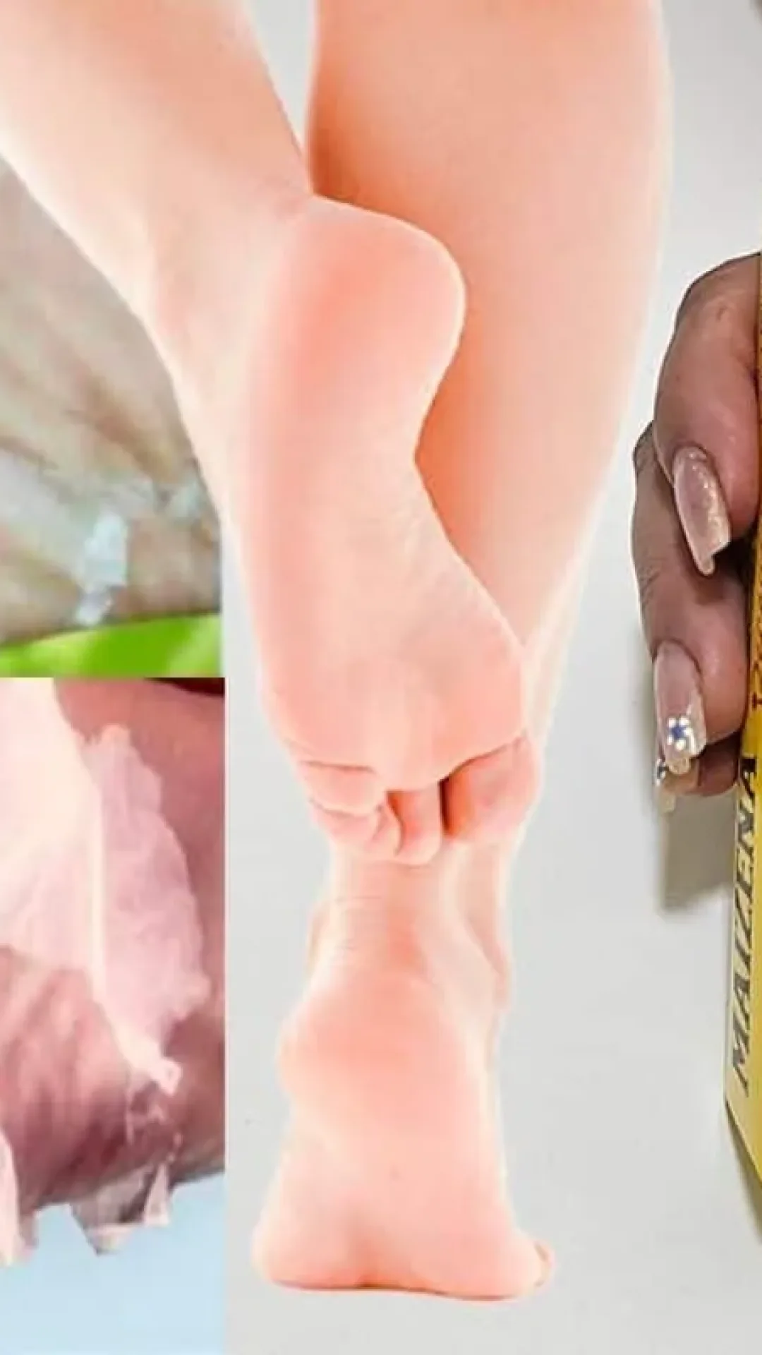 Como tirar rachadura dos pés: solução caseira que funciona para acabar com a pele seca e deixar os pés macios.