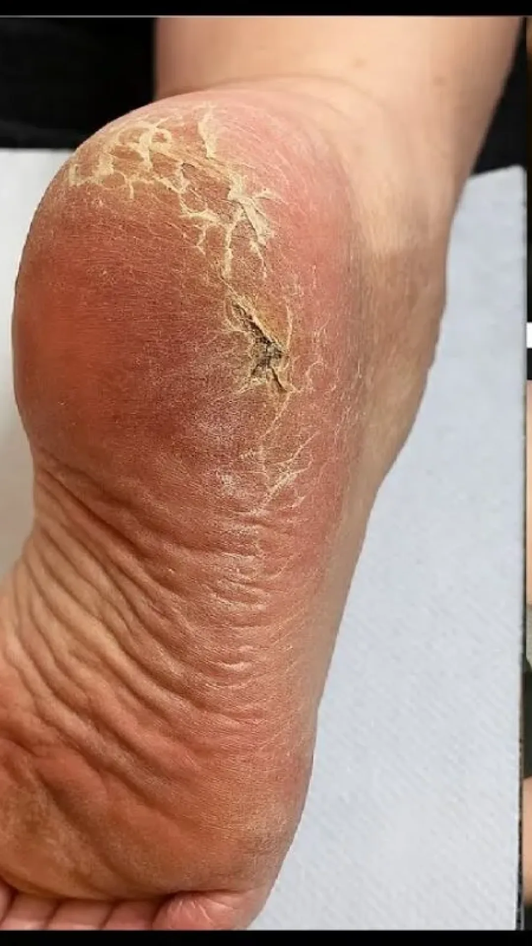 Como tirar rachaduras dos pés com receita simples que funciona sem precisar de médico