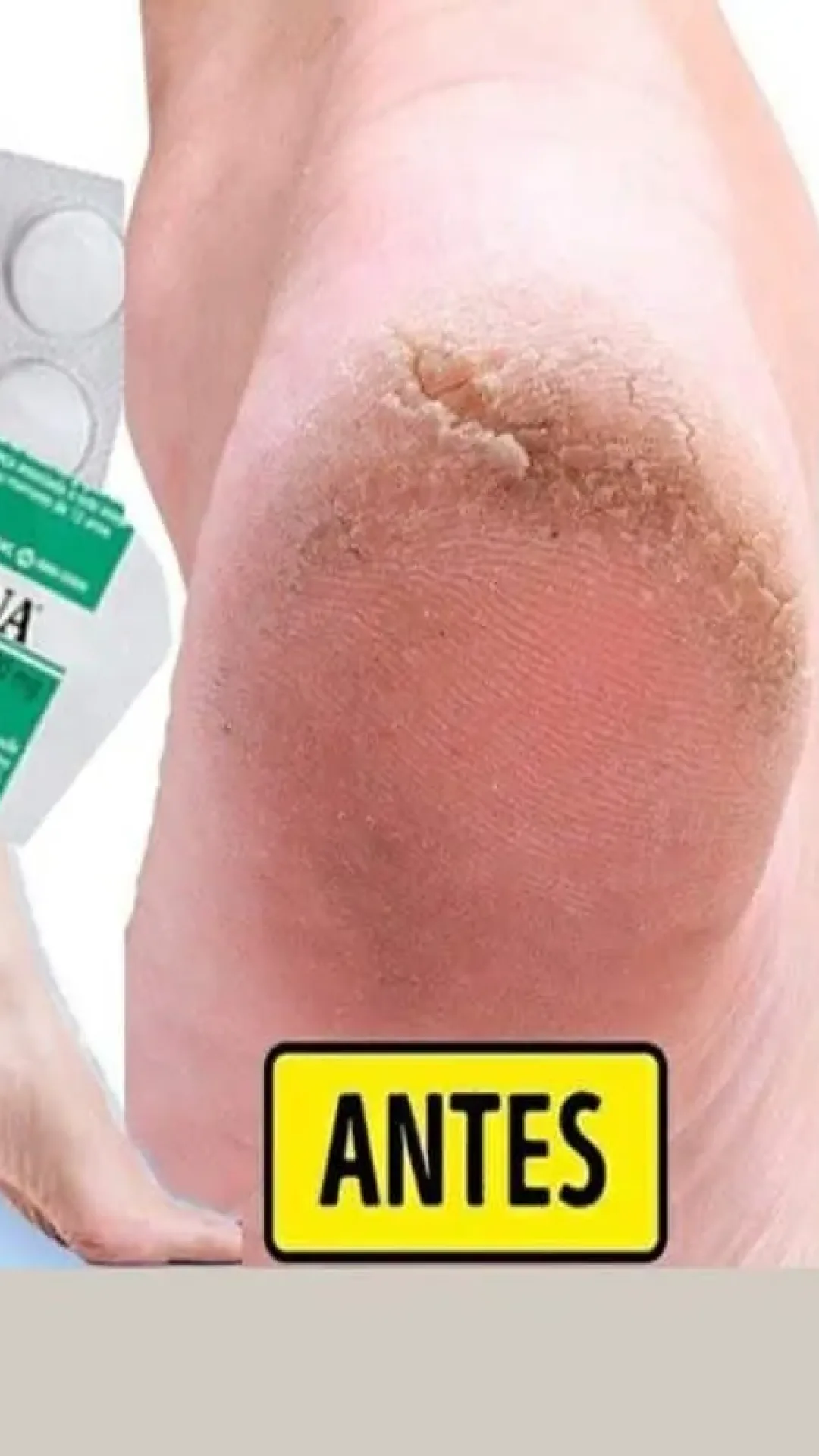 Hidratante caseiro para pés rachados que deixa a pele lisinha
